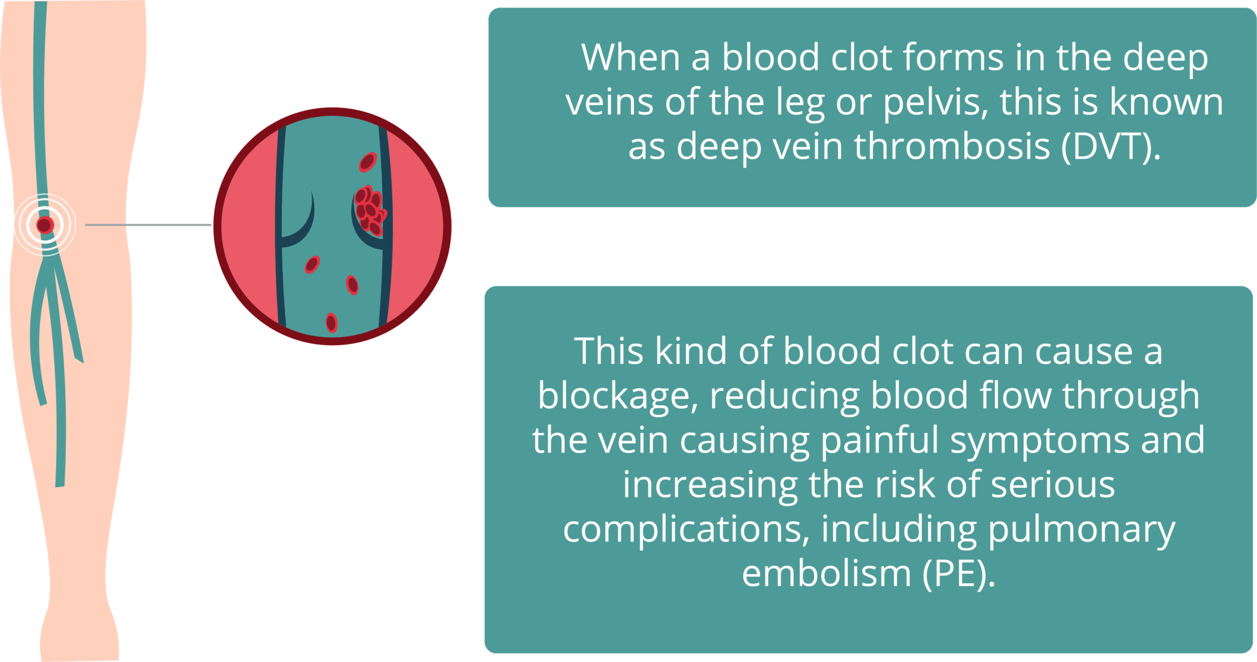 Deep Vein Thrombosis: Causes, Symptoms, Risk Factors, Diagnosis, Treatment,  Prevention and Complications