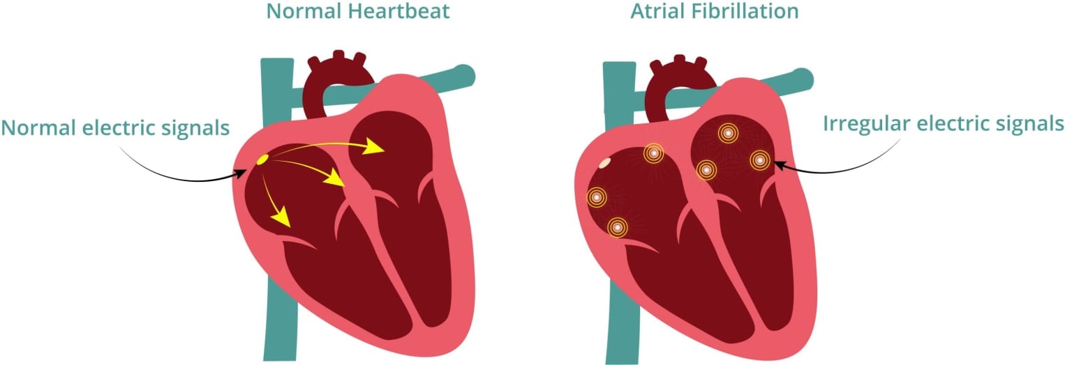 What is fibrillation? | The Perth Blood Institute Limited